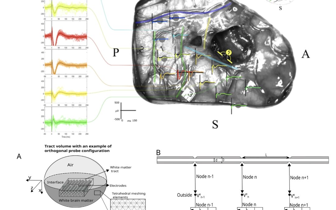 Guider la chirurgie du cerveau grâce à l’électrophysiologie évoquée