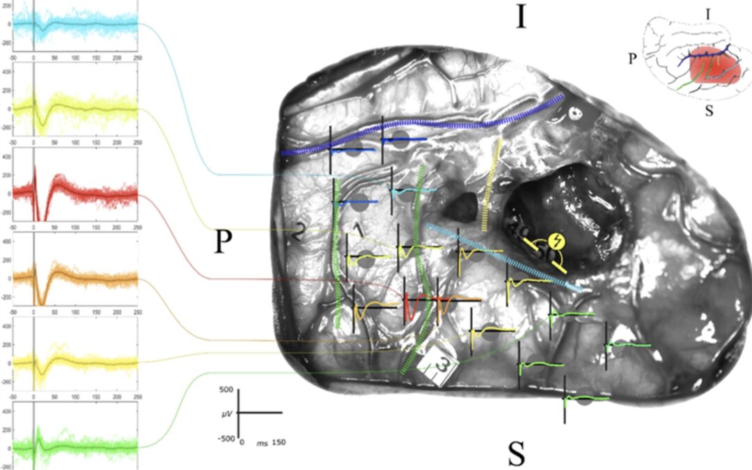 Guider la chirurgie du cerveau grâce à l’électrophysiologie évoquée